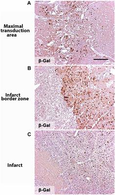 Adenoviral VEGF-DΔN ΔC gene therapy for myocardial ischemia